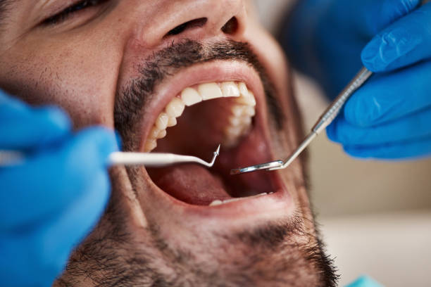 Best Emergency Dentist for Lost Fillings or Crowns in Mount Vernon, IA